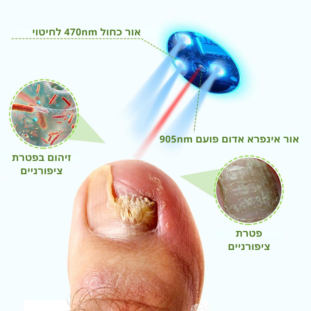 ClearNailPro™ – מכשיר לייזר מתקדם לטיפול מהיר בפטרת ציפורניים